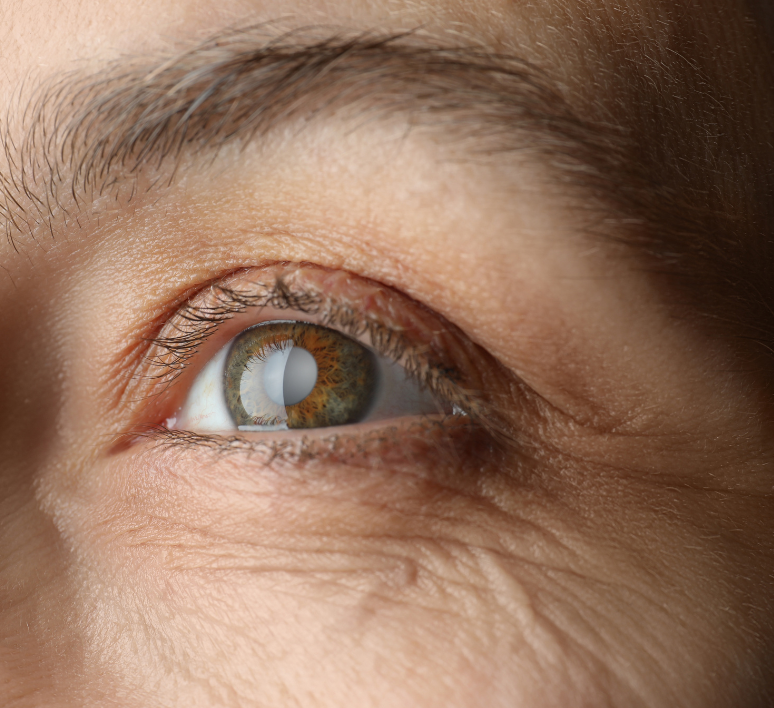 Comprendre la cataracte : causes, symptômes et solutions